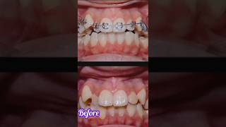 Orthodontic treatment braces orthodontics brackets [upl. by Krissy]