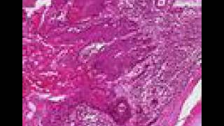 Histopathology Lung  Squamous cell carcinoma [upl. by Ahtibbat]