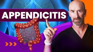 Appendicitis When SHOULD I Go To The Doctor [upl. by Nissa636]