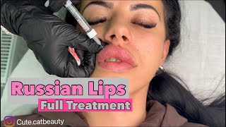 Russian Lip Technique  Lip Filler REVOLAX Deep [upl. by Yelime756]