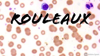 Rouleaux Formation Erythrocytes on Peripheral Blood Smear in Multiple Myeloma Hemepath Hematology [upl. by Eilerua]