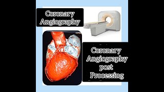 Coronary angiography post processing techniques on Philips 128 slice MRI [upl. by Ivor]