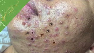 Most Satisfying And Attractive Video With Xinh Spa New 2022 03 Treatment for Khang part 3 [upl. by Aicatsan120]