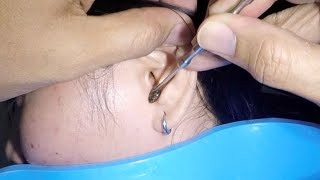 Removing Huge Earwax Stuck in Womans Ear [upl. by Magavern]