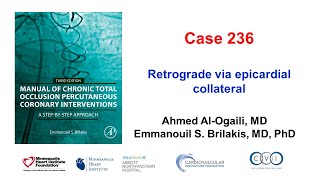 Case 236 Manual of CTO PCI  Retrograde via epicardial collateral [upl. by Ettenwad]