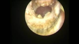 Resection of obstructed Ejaculatoryduct TUED [upl. by Esirrehc]