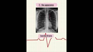 RADIOLOGICAL SIGNS IN CARDIOLOGY 🫀 CARDIOLOGY  CXR radiology viral shorts [upl. by Bertrand338]