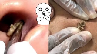 Ultimate Compilation Satisfying Blackhead Removal and Acne Treatment Highlights [upl. by Jacinto596]