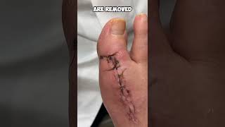 Watch How Easy and Painless Suture Removal Can Be [upl. by Azriel559]