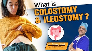 What is colostomy amp ileostomy  Stoma Bag Kya hai Dr Neeraj Goel [upl. by Arahc746]