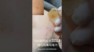 레이저 흑자 제거 치료 시술 가격 비싼 리팟레이저 아니여도 깨끗하게 제거 가능 리팟레이저lentigo laser removal treatment [upl. by Oinotla]