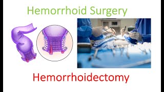 What is hemorrhoidectomy surgery Get the REAL details here  Dr Chung explains [upl. by Dorisa]