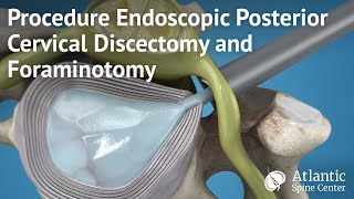 Procedure Endoscopic Posterior Cervical Discectomy and Foraminotomy [upl. by Chloras965]