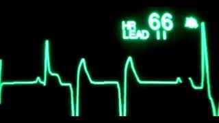 Progression of MI to — ventricular ectopic beats to — VT to— VF to — a systole [upl. by Jephthah]