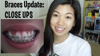 Braces Update  Longer springs and close ups 7 months [upl. by Ecadnak]