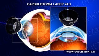 Cataratta secondaria capsulotomia laser YAG [upl. by Eberle]