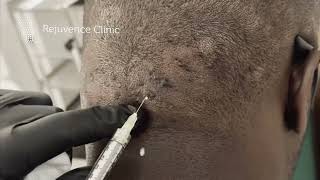 Intralesional Steroid Injections for Acne Keloidalis Nuchae rejuvenceclinic91 [upl. by Noreh997]