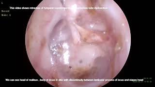 Grade IV Tympanic membrane retraction [upl. by Elmira]