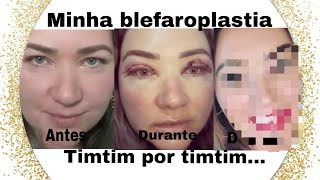 TODA VERDADE SOBRE A MINHA BLEFAROPLASTIA Antes durante e depois [upl. by Drofkcor416]