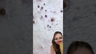 Blackheads Removal  Acne Treatment and Very Satisfying Satisfying Pimple pop blackheads [upl. by Courtney445]