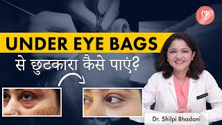 Under eye bags कैसे हटाएं  Eyelid Surgeon in Gurgaon  Dr Shilpi Bhadani  Dr Shilpi Bhadani [upl. by Sou]