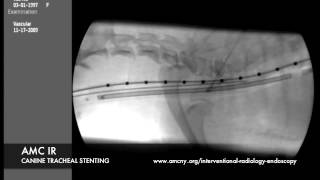 AMC IR tracheal stent [upl. by Ecyal]