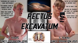 5 Years On From My Ravitch Procedure To Correct My Pectus Excavatum Advice amp Support [upl. by Sophronia856]