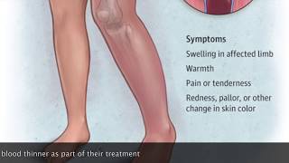 Isolated Calf Vein Thrombosis DVT Below the Knee [upl. by Biebel239]