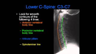 Radiology of Spine Trauma [upl. by Adlay536]