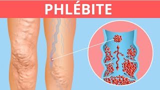 Phlébite  Symptômes Causes et Traitement [upl. by Atteloc]