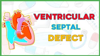 Ventricular Septal Defect VSD Pathophysiology clinical features diagnosis treatmentpediatrics [upl. by Meensat]