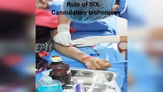 AVF Cannulation techniques  Dialysis patient cannulation dcdc ttt [upl. by Bouldon]