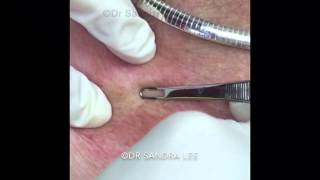 Four minor Derm procedures Milia a blackhead amp a tag For medical education NSFE [upl. by Buschi175]