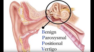 Benign Paroxysmal Positional Vertigo BPPV Symptoms and Causes  Diagnosis  Treatment  Prevention [upl. by Christan]