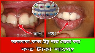 আঁকাবাঁকা দাঁত সোজা করতে কত টাকা লাগবে  orthodontic treatment in bangladesh  স্বাস্থ্য সেবা [upl. by Patrizius]