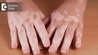 What are the causes of vitiligo  Dr Aruna Prasad [upl. by Obellia945]