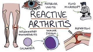 Understanding Reactive Arthritis [upl. by Nomrac30]