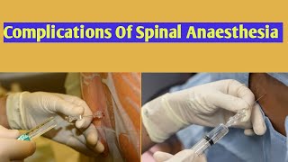 Spinal AnaesthesiaComplications Of Spinal AnesthesiaSpinal Anesthesia Complications [upl. by Hsekin]