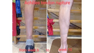 Achilles tendon rupture 610 week Rehabilitation protocol Riabilitazione rottura tendine dAchille [upl. by Ariamoy]