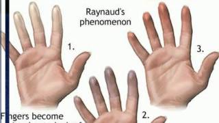 The best ways to Relieve Hands Pain in Raynauds Disease Sufferers [upl. by Netsirc306]