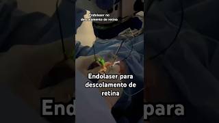 Vitrectomia com endolaser para descolamento de retina [upl. by Eerak]