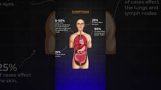 Know About Sarcoidosis I Akshar Pulmo Care sarcoidosis lungshealth science education [upl. by Epoillac]