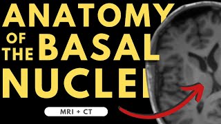 Basal ganglia basal nuclei neuroanatomy  Radiology anatomy part 1 prep  MRI  CT [upl. by Millisent]