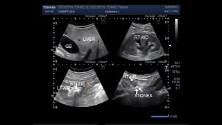 Stone at PUJ and two ureteric stones [upl. by Aset]