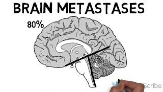 Brain Metastases [upl. by Inimod97]