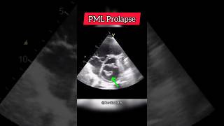 Prolapse of posterior Mitral Valve leaflet on Echocardiographg heart echocardiogram [upl. by Silverstein]