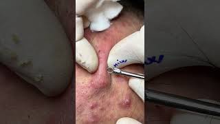 The Battle Against FullFace Infected Acne A Meticulous Extraction Process [upl. by Aidyn]