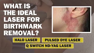 Is Halo Laser Treatment Ideal for Birthmark Removal Birthmark Removal in Delhi  Dr PK Talwar [upl. by Lertram709]