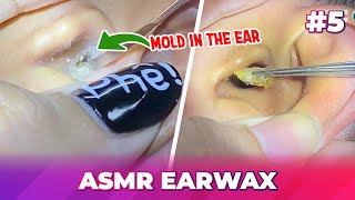 Ep5 Earwax ASMR  This earwax removal moment will put you at ease [upl. by Adnawyek697]