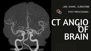 CT Angiography Brain Post Process of Filming [upl. by Namwen]